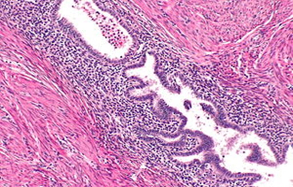 Micrograph showing a histological section of tissue stained with hematoxylin and eosin, displaying glandular structures and surrounding stromal tissue.